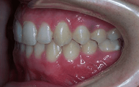 Side view of impacted teeth on patient - After treatment