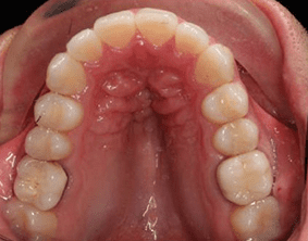 Top view of open bite teeth on patient - After treatment