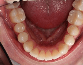 Bottom view of open bite teeth on patient - After treatment