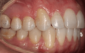 Side view of open bite teeth on patient - After treatment