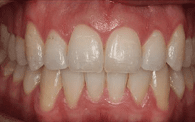 Front view of open bite teeth on patient - After treatment