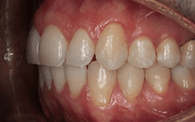 Side view of open bite teeth on patient - After treatment