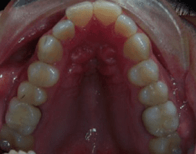 Top view of open bite teeth on patient - Before treatment