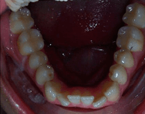 Bottom view of open bite teeth on patient - Before treatment