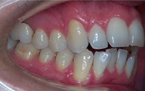 Side view of open bite teeth on patient - Before treatment