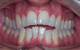 Front view of open bite teeth on patient - Before treatment