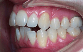 Side view of open bite teeth on patient - Before treatment