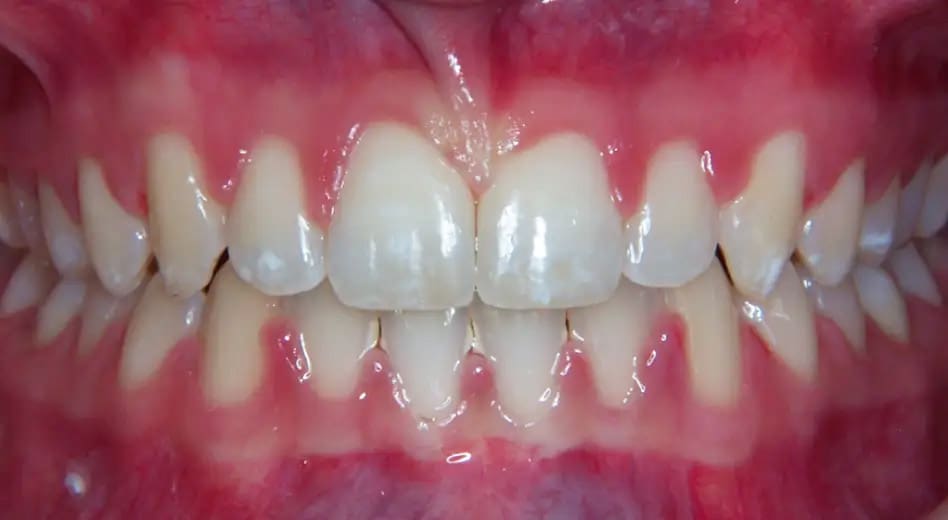 Front view of orthodontic treatment on patient - After treatment