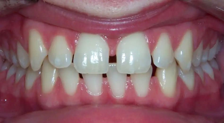 Front view of orthodontic treatment on patient - Before treatment