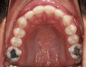 Top view of spacing and gaps on patient - After treatment