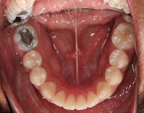 Bottom view of spacing and gaps on patient - After treatment