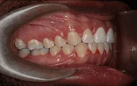 Side view of spacing and gaps on patient - After treatment