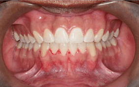 Front view of spacing and gaps on patient - After treatment