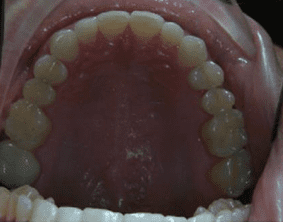 Top view of spacing and gaps on patient - After treatment