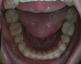 Bottom view of spacing and gaps on patient - After treatment