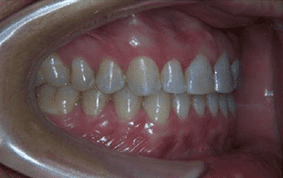 Side view of spacing and gaps on patient - After treatment