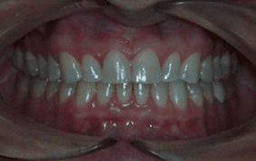 Front view of spacing and gaps on patient - After treatment