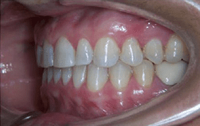 Side view of spacing and gaps on patient - After treatment