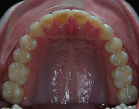 Top view of spacing and gaps on patient - After treatment