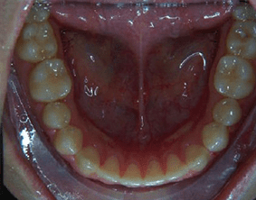 Bottom view of spacing and gaps on patient - After treatment