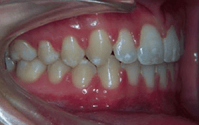 Side view of spacing and gaps on patient - After treatment