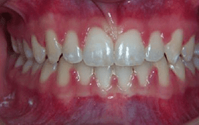 Front view of spacing and gaps on patient - After treatment