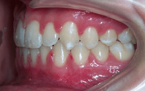 Side view of spacing and gaps on patient - After treatment