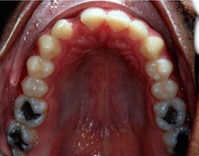 Top view of spacing and gaps on patient - Before treatment