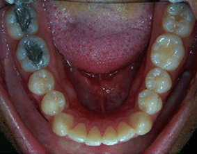 Bottom view of spacing and gaps on patient - Before treatment