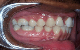 Side view of spacing and gaps on patient - Before treatment