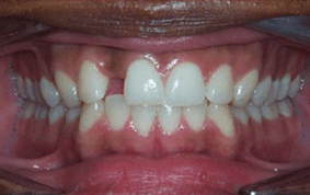 Front view of spacing and gaps on patient - Before treatment