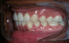 Side view of spacing and gaps on patient - Before treatment