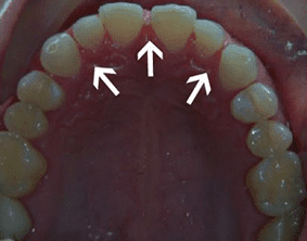 Top view of spacing and gaps on patient - Before treatment