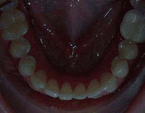 Bottom view of spacing and gaps on patient - Before treatment