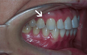 Side view of spacing and gaps on patient - Before treatment