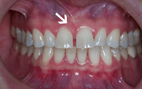 Front view of spacing and gaps on patient - Before treatment