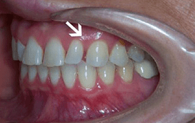 Side view of spacing and gaps on patient - Before treatment