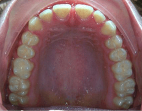 Top view of spacing and gaps on patient - Before treatment