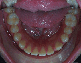 Bottom view of spacing and gaps on patient - Before treatment