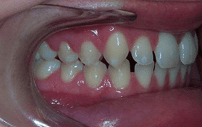 Side view of spacing and gaps on patient - Before treatment