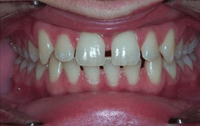 Front view of spacing and gaps on patient - Before treatment