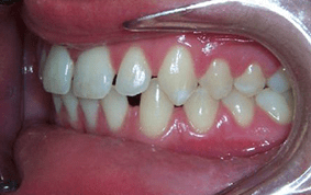 Side view of spacing and gaps on patient - Before treatment