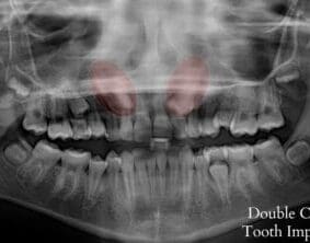 Xray of impacted tooth