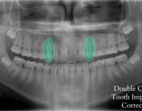 Xray of impacted tooth